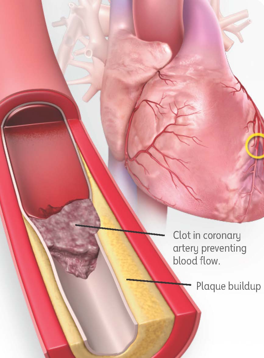 Heart Attack Blockage